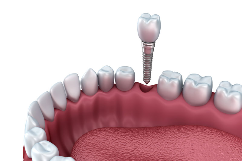 Periodontists are specialists in periodontal disease and dental implants.